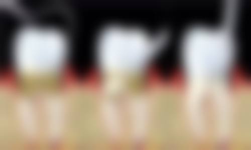 贴面方案设计——改善牙齿美观的好选择