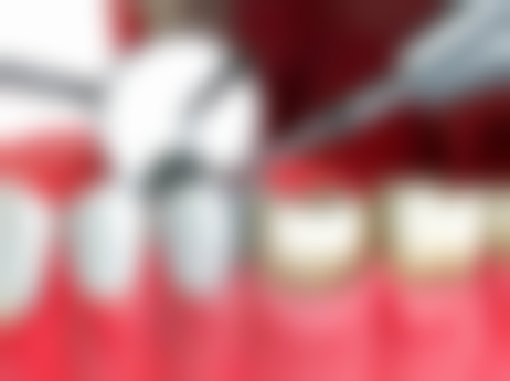 贴面方案设计——改善牙齿美观的好选择